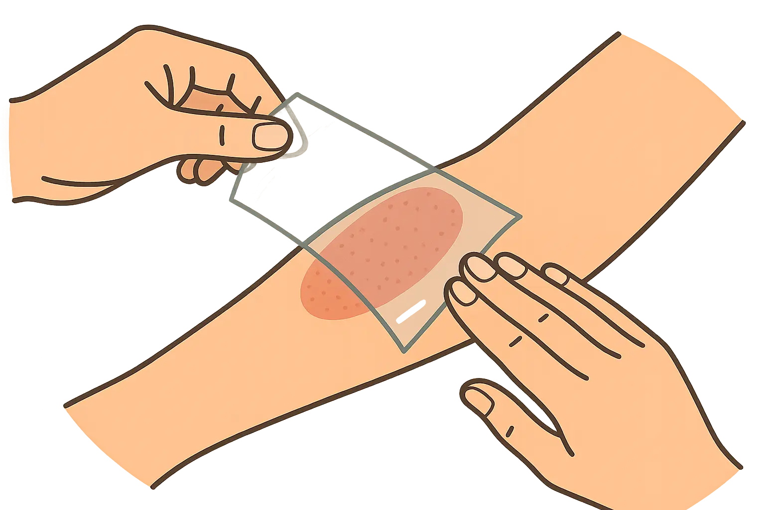 Saniderm original transparent film application